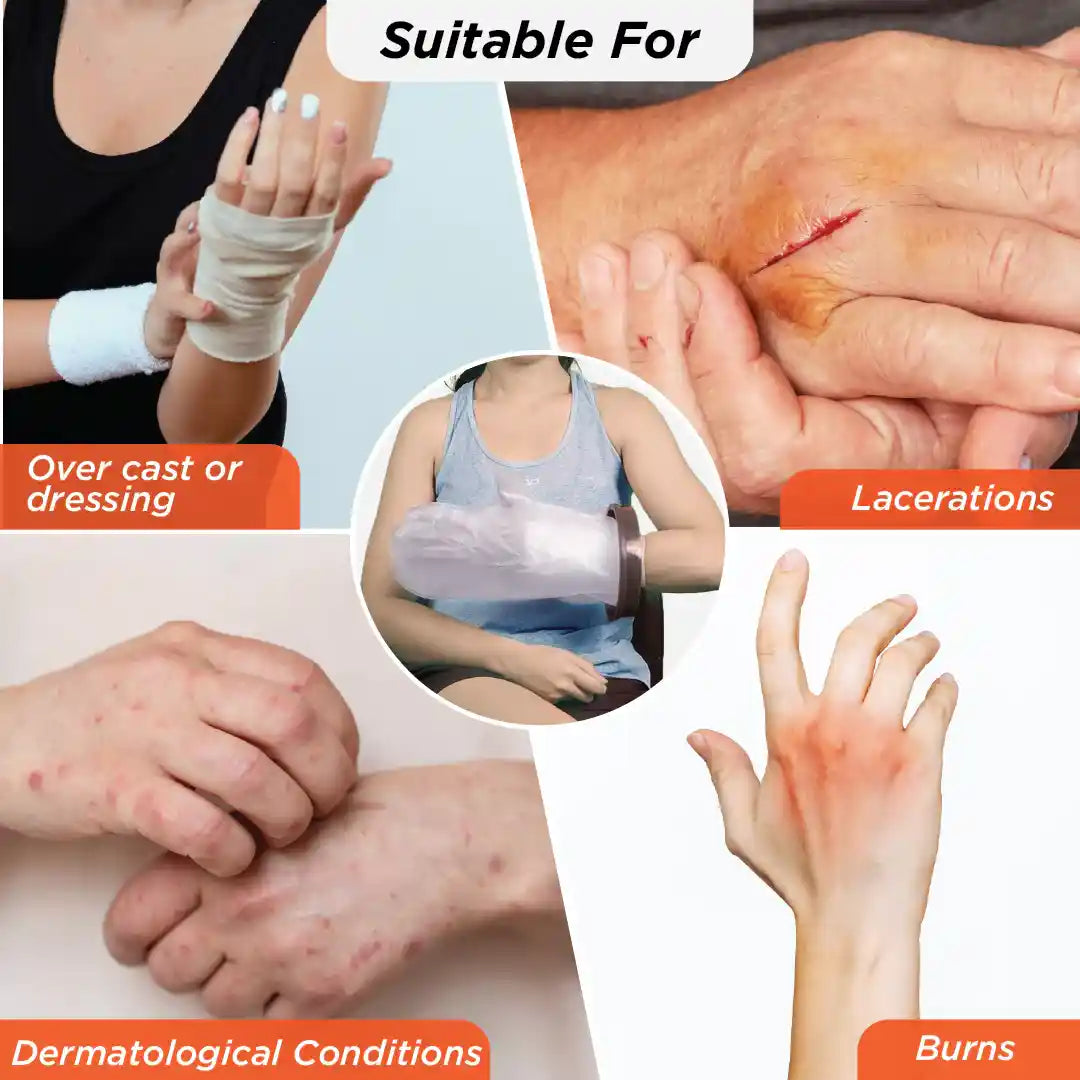 VISSCO Cast Cover for Hand